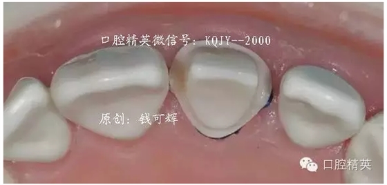 为什么你的牙齿备不好