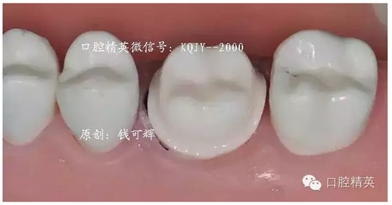 为什么你的牙齿备不好