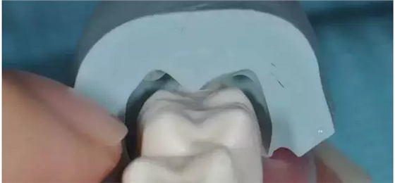 为什么你的牙齿备不好