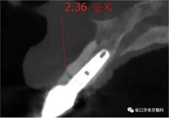 右上前牙即刻种植即刻修复1例
