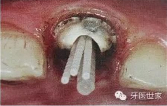 纤维桩临床操作步骤