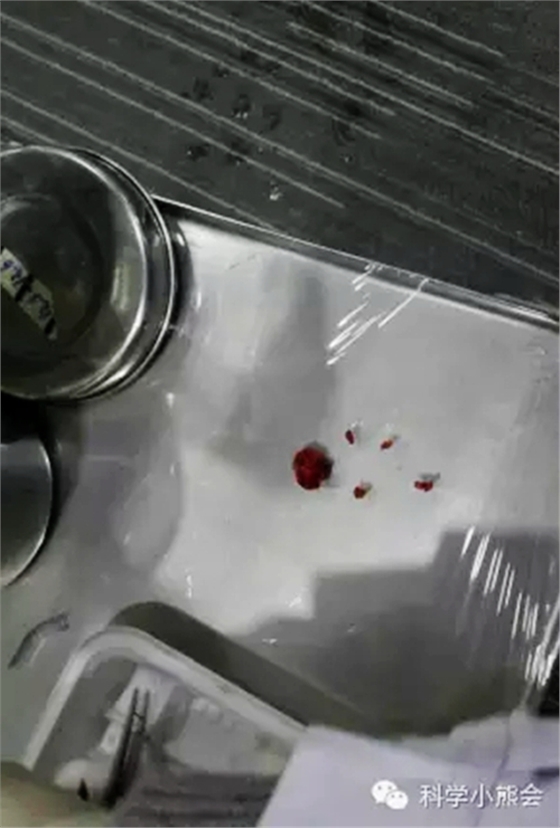 粘液腺囊肿