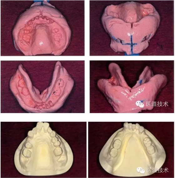 全口拔牙即戴全口活动义齿修复病例 