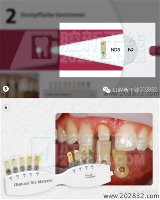义获嘉 Ivoclar Vivadent 比色板 A-D16色 Ivoclar Shade Guide A-D16