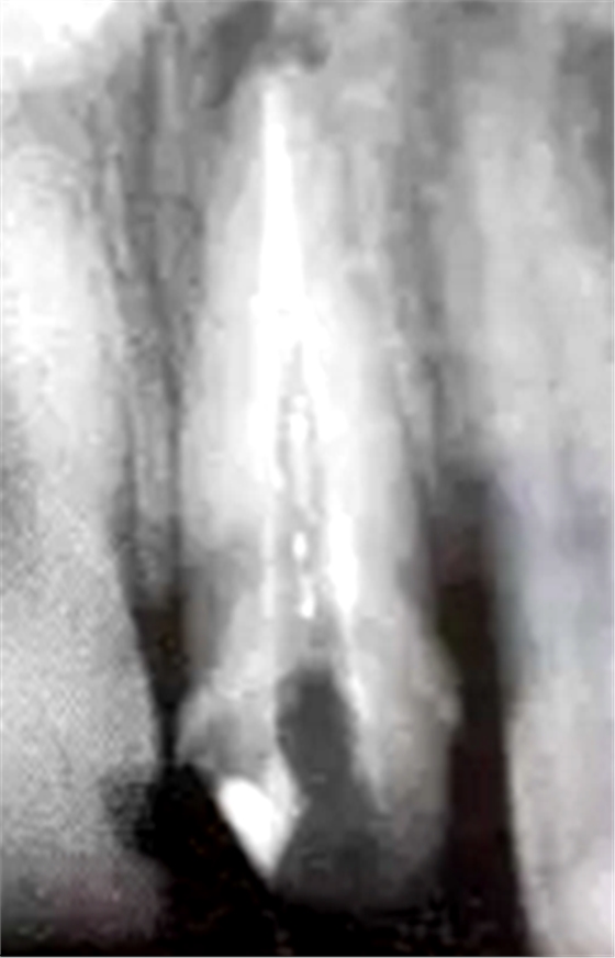 纤维桩修复之精细操作