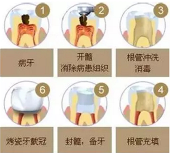 医生，牙齿折断不是应该补上去吗，为啥要做根管治疗？