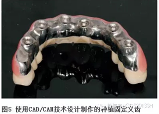 【经验分享】无牙颌种植修复固位的并发症与处理——宋应亮教授