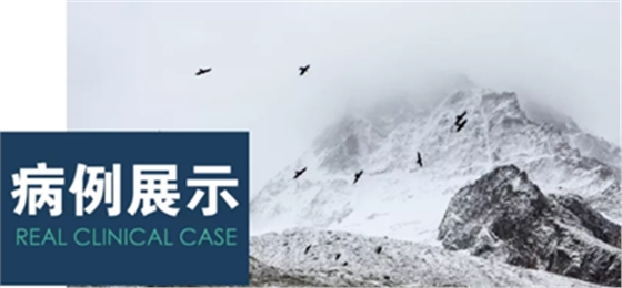 病例赏析 | 上颌窦外提升长期成骨观察