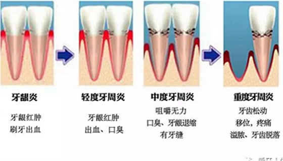 牙龈萎缩怎么办？