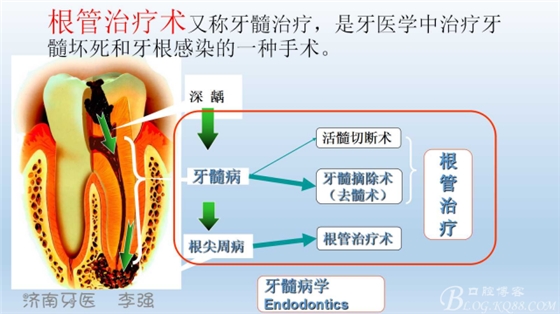 根管再治疗，高嵌体即可修复（济南牙医~ 李强）