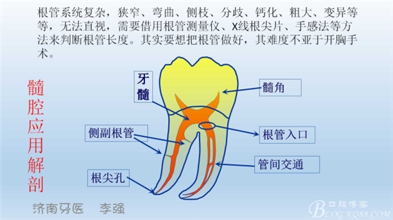 根管再治疗，高嵌体即可修复（济南牙医~ 李强）
