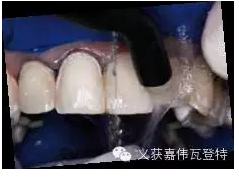 义获嘉贴面粘接的操作步骤！