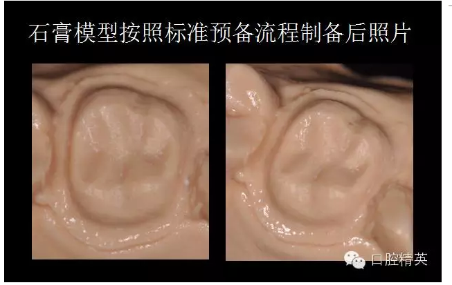 为什么你的牙齿备不好