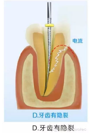 让你知道根管测量受影响的原因