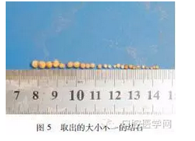 	下颌下静脉畸形伴多发静脉石误诊为涎石病1例