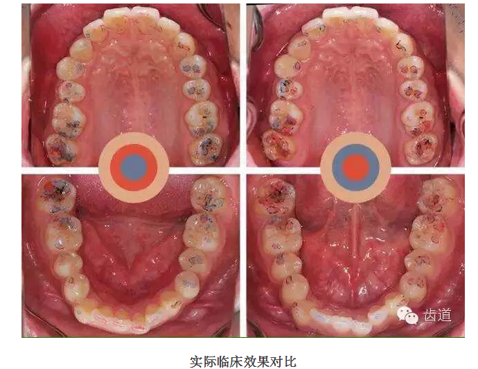 牙科咬合纸的用法