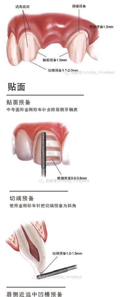 时常搞不清楚怎么备牙吗？义获嘉教您如何完美备牙
