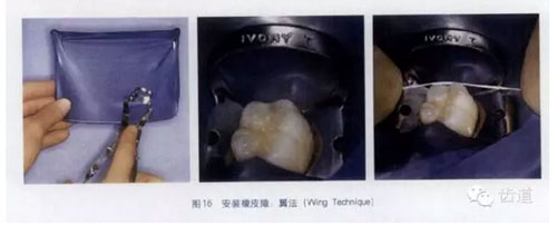橡皮障的临床运用大全 橡皮障的临床运用大全