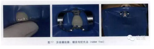 橡皮障的临床运用大全 橡皮障的临床运用大全