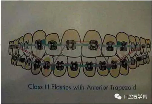 正畸damon system橡皮筋(elastics)挂法示意图
