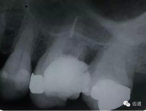 根管治疗的并发症及处理