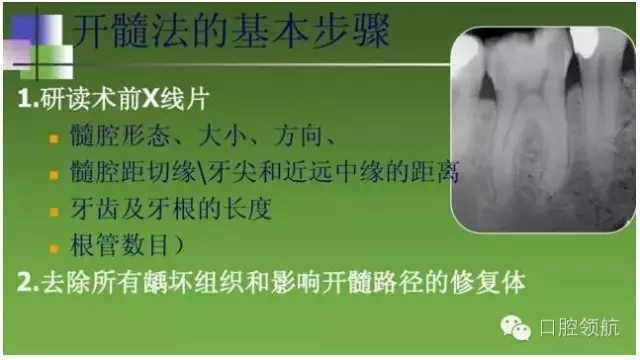 开髓术