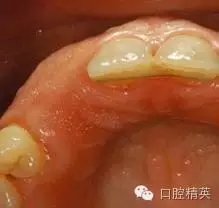 口腔种植各种失败模式的病因探查