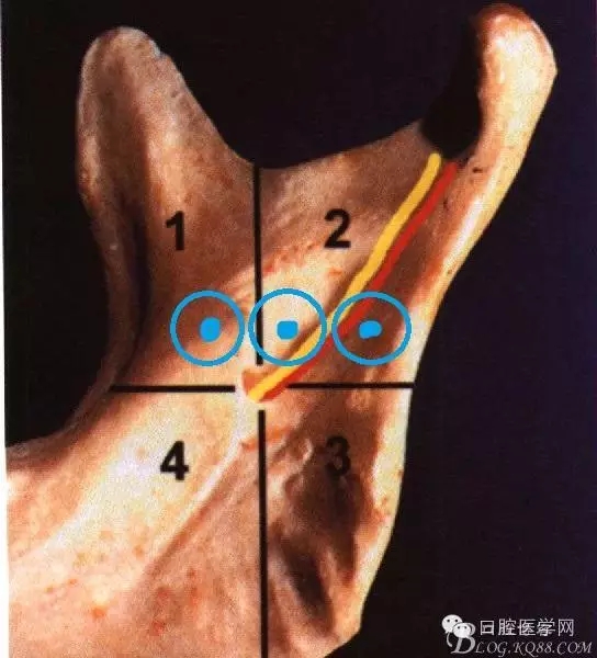 即使是老手也会失手的麻醉----下牙槽、舌、颊一次阻滞麻醉
