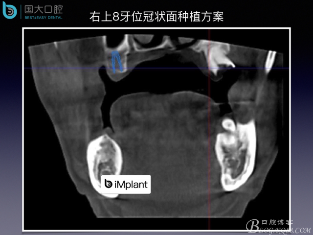 上颌窦底区域严重骨吸收的临床种植案例.jpeg