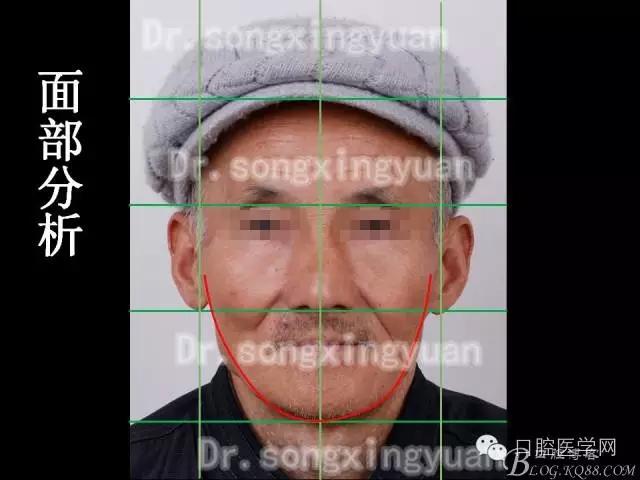 种植牙全口咬合重建