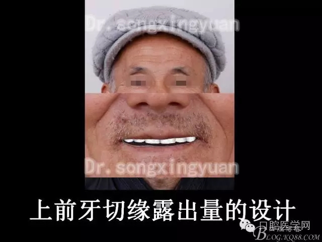 种植牙全口咬合重建