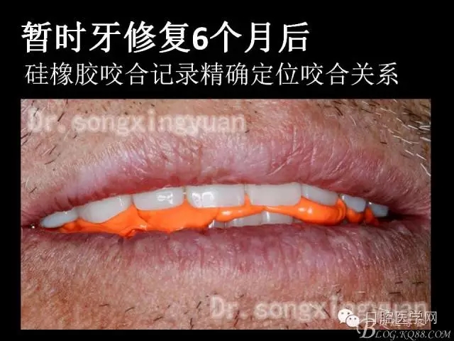 种植牙全口咬合重建