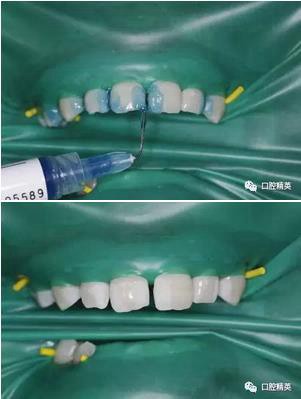 图解：前牙间隙关闭过程