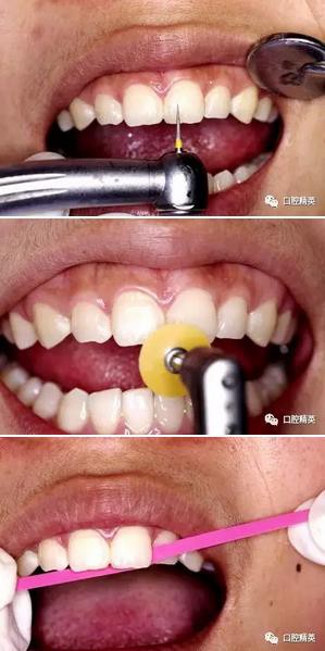 图解：前牙间隙关闭过程