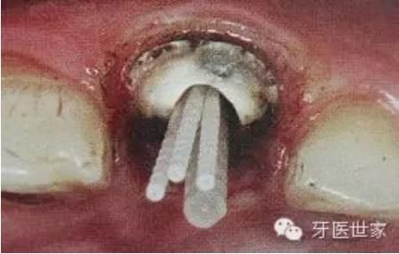纤维桩临床操作步骤