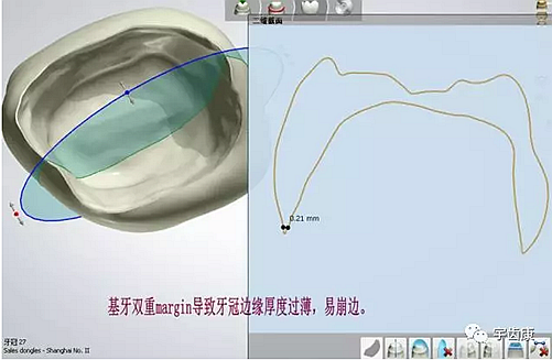 影响全瓷牙冠裂的因素有哪些？