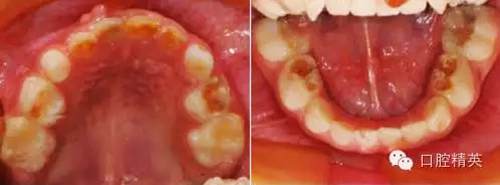 全麻下儿科治疗+儿牙树脂充填