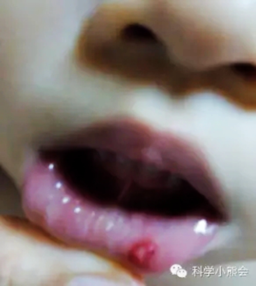 粘液腺囊肿