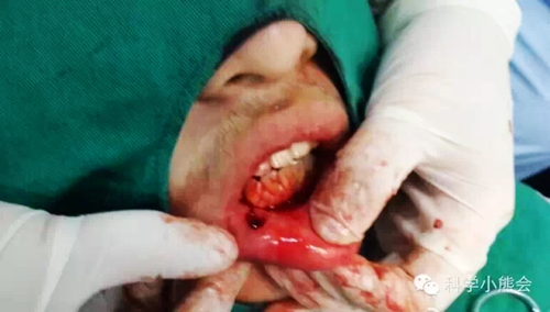 粘液腺囊肿