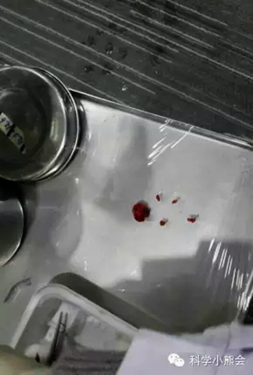粘液腺囊肿