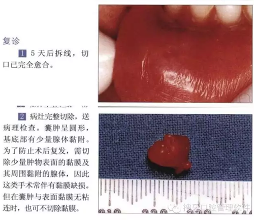 粘液腺囊肿切除术
