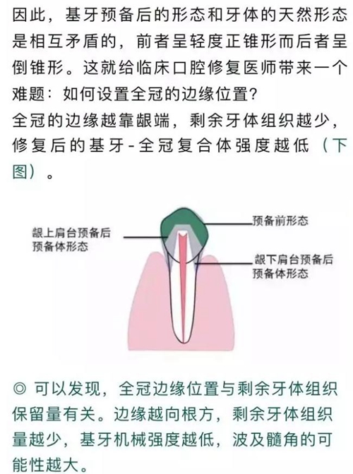 做全冠修复时基牙根面暴露，如何备牙？