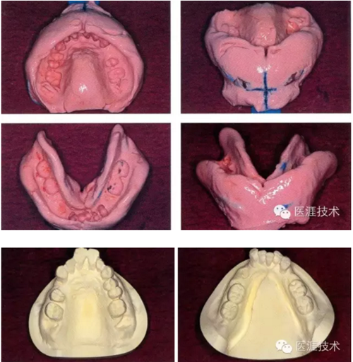 全口拔牙即戴全口活动义齿修复病例 