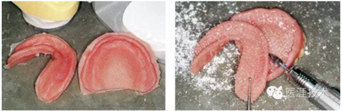 全口拔牙即戴全口活动义齿修复病例 