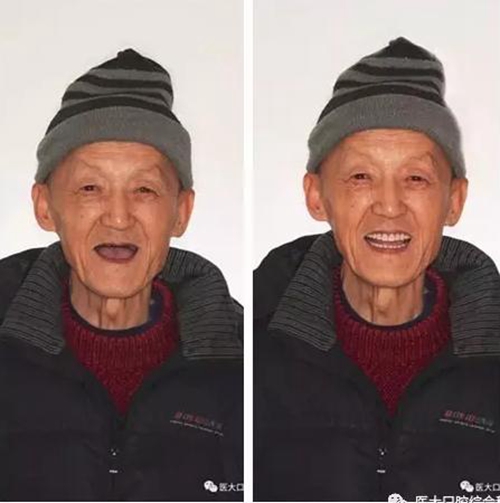 医大口腔综合科 |“镶牙”的学问——活动类 