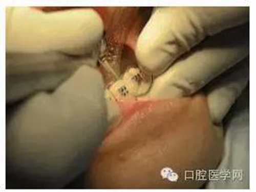 邻面去釉的操作与注意事项 