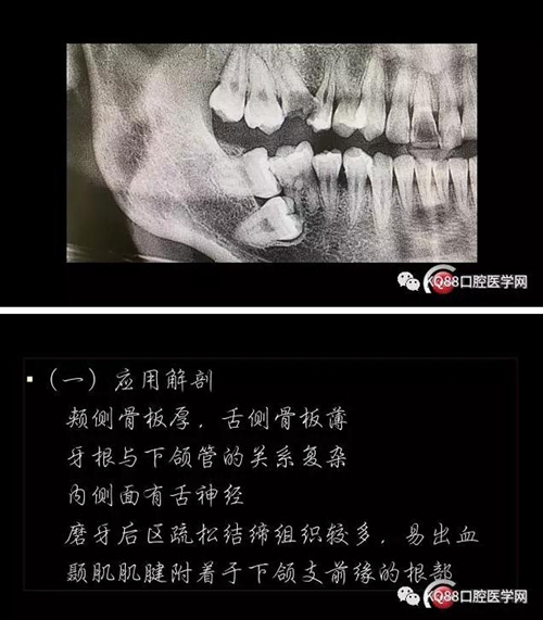 智齿拔除