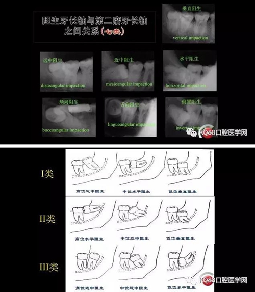 智齿拔除