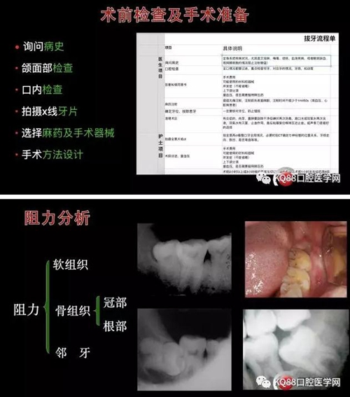 智齿拔除