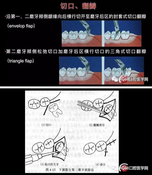 智齿拔除